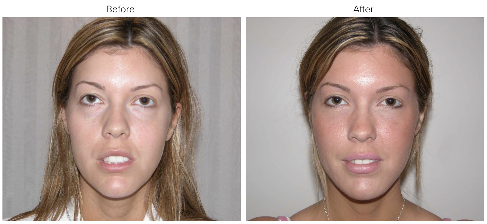 Stephani recommends best of Facial fat grafting bruising bruising grafting Facial fat